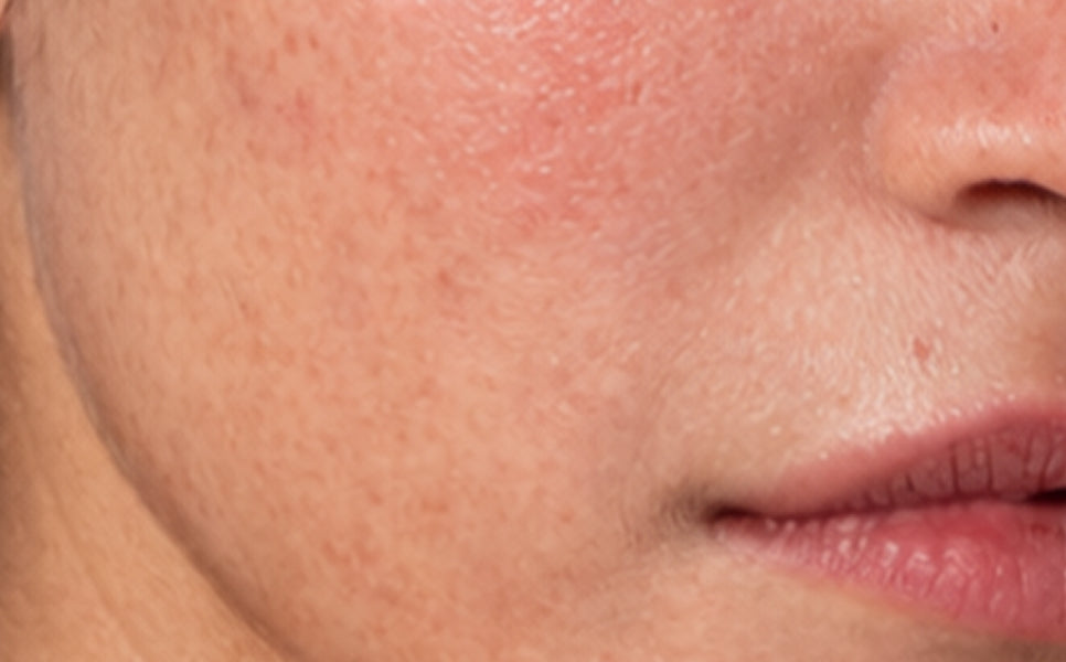 Skin before using the Hydrating Barrier Cream