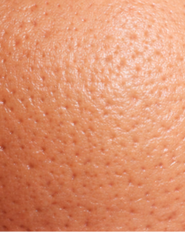 oily skin texture